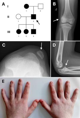 Case Report: Inversion of LMX1B - A Novel Cause of Nail-Patella Syndrome in a Swedish Family and a Longtime Follow-Up